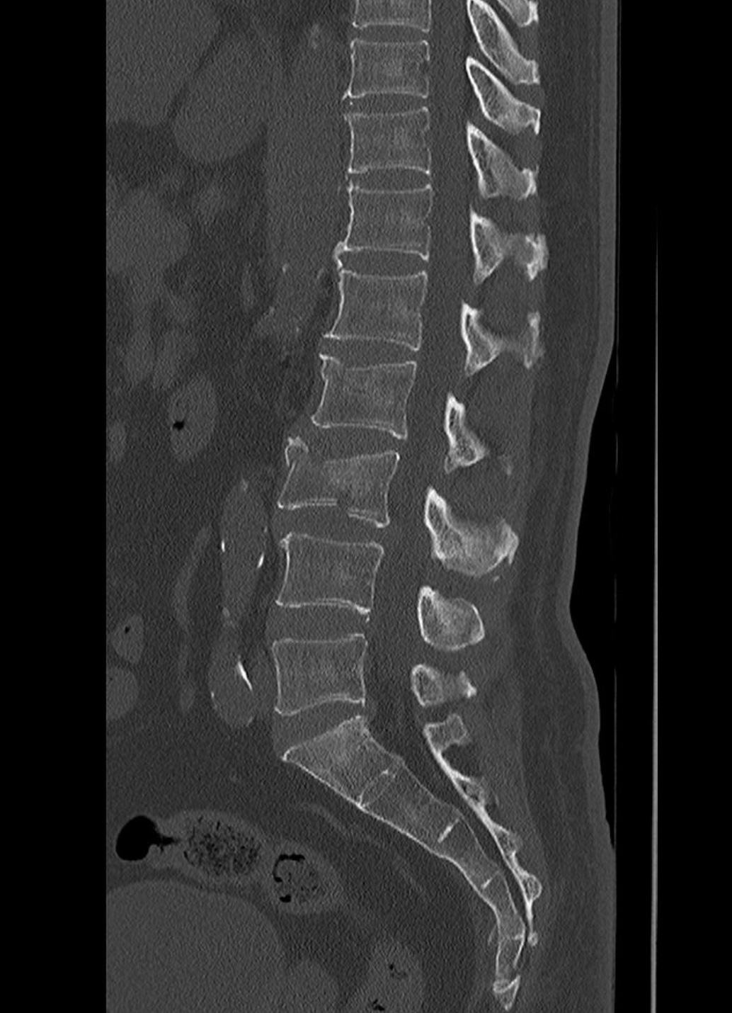 術前 CT 顯示 L1、L2 腰椎壓迫性骨折