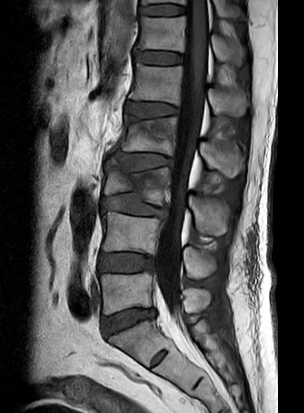 術前 MRI 顯示 L1、L2 腰椎壓迫性骨折，未見明顯神經壓迫