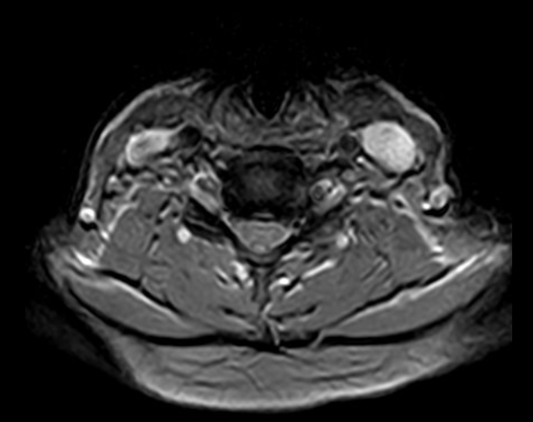 術前頸椎 MRI 橫切面顯示 C5/6 椎間盤突出與左側神經根壓迫