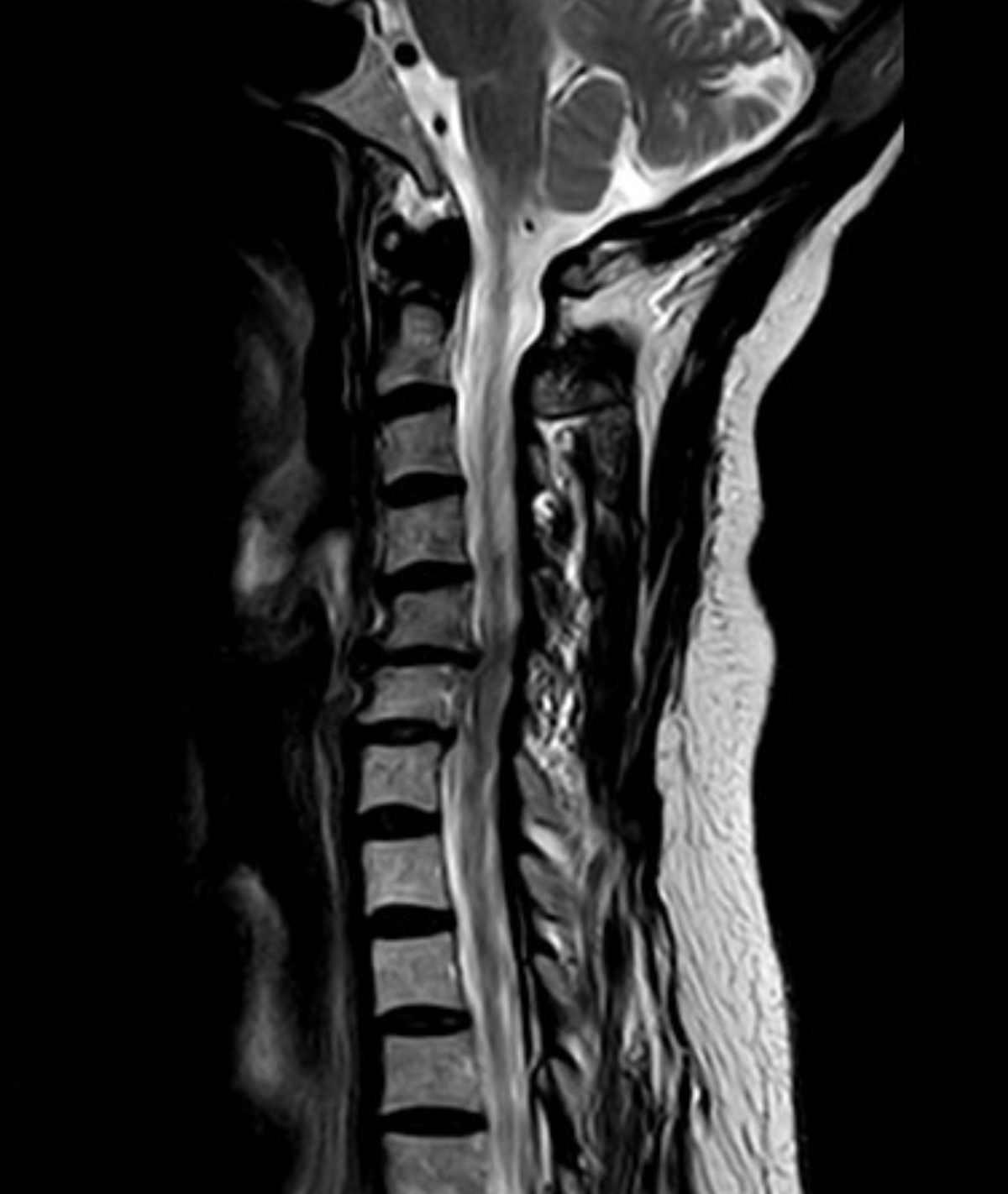 術前頸椎 MRI 顯示 C5/6 椎間盤突出與狹窄，合併左側神經根壓迫