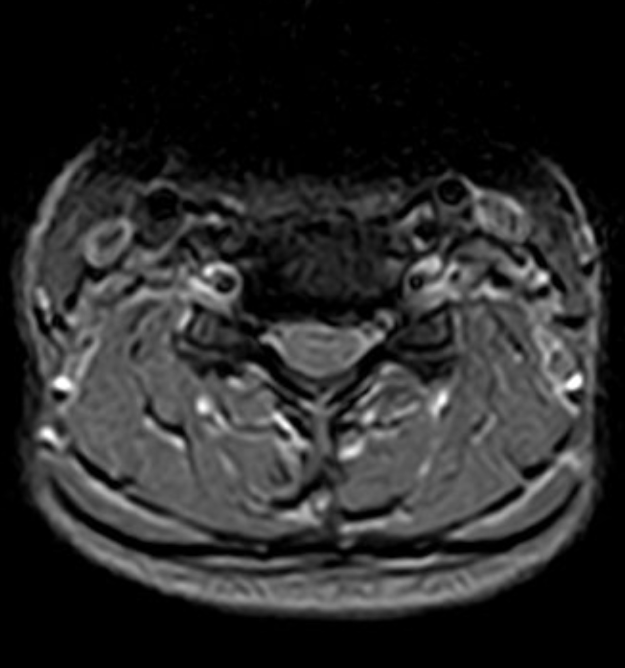 術前頸椎 MRI 影像顯示 C5/6 椎間盤突出