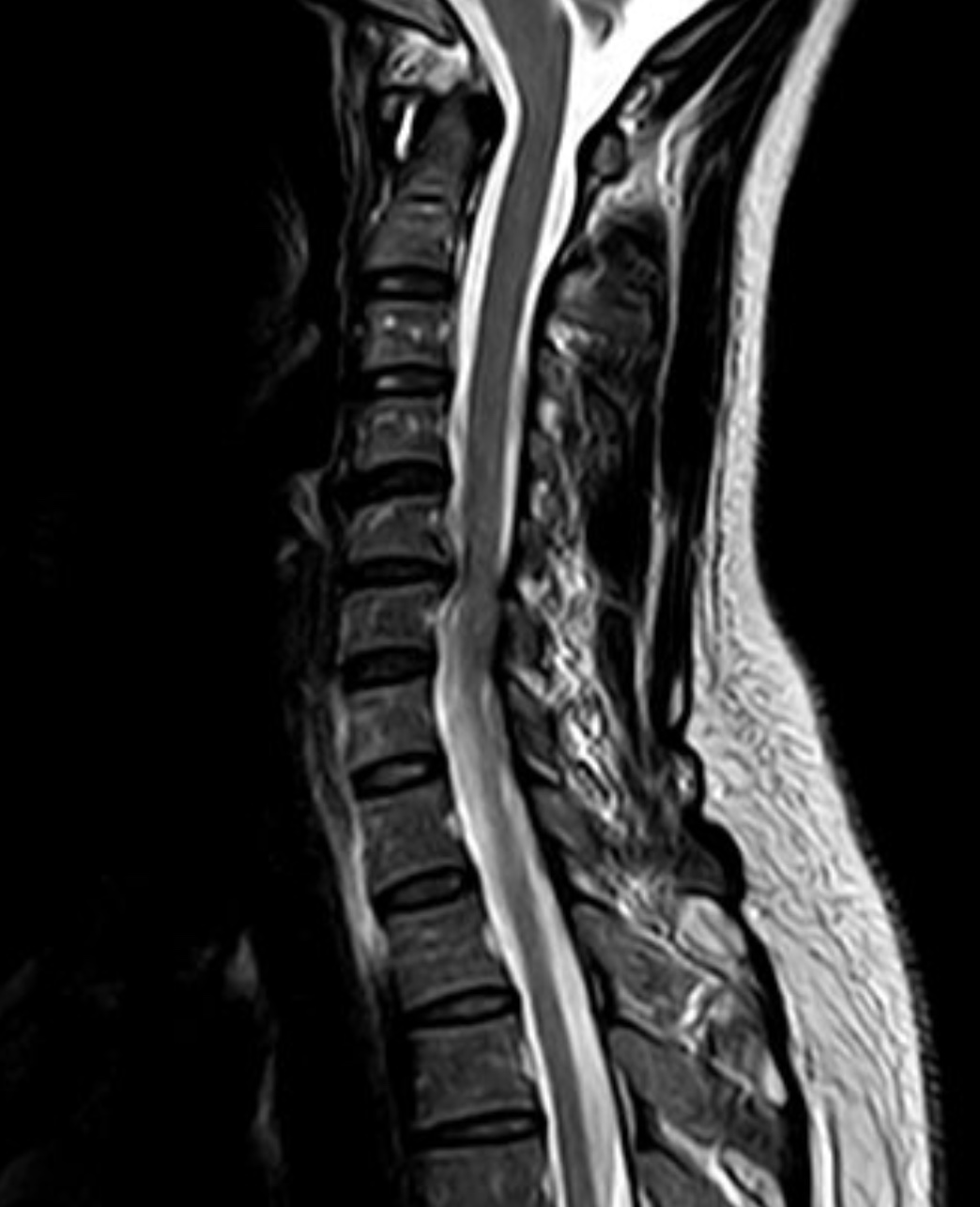 術前頸椎 MRI 顯示 C5/6 椎間盤突出合併神經壓迫