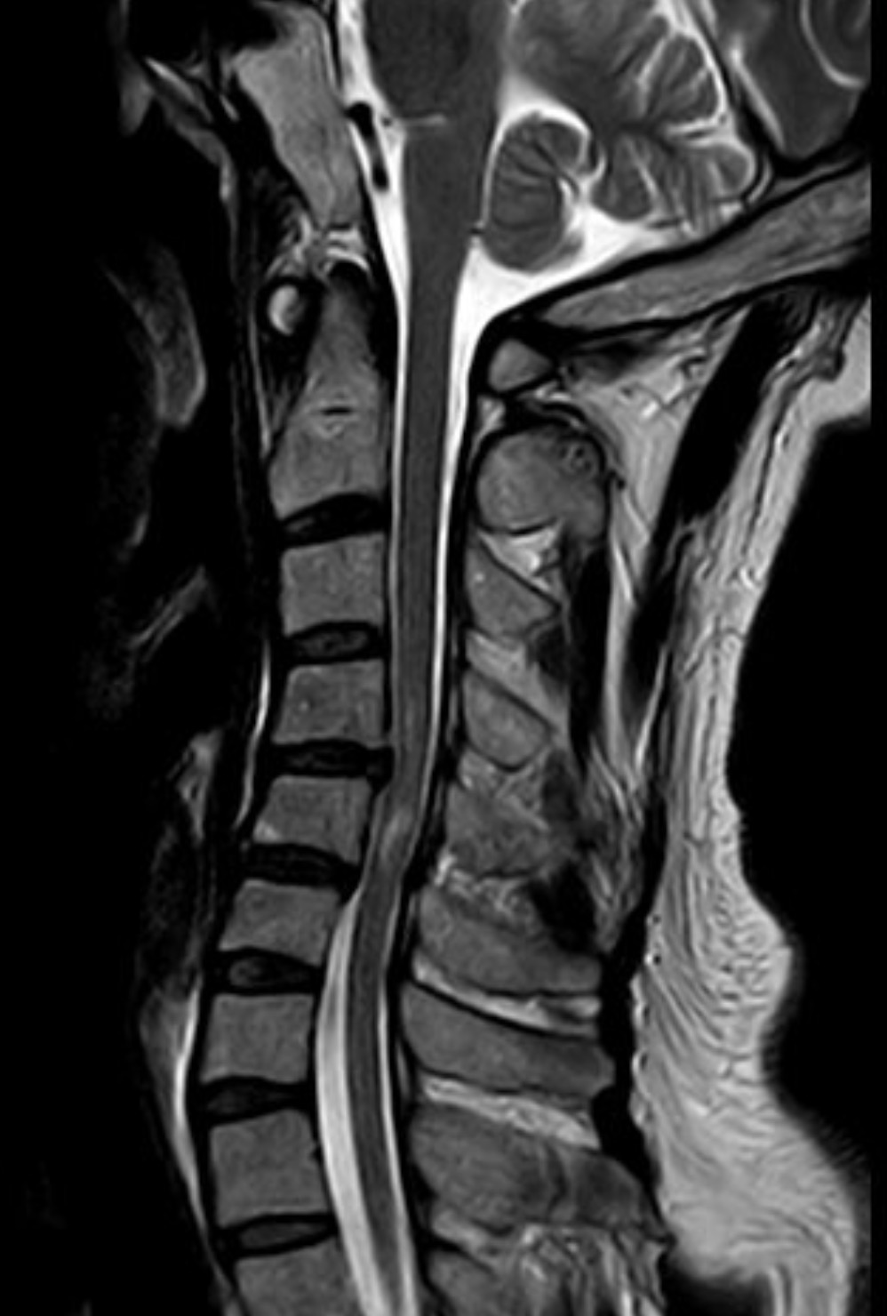 術前頸椎 MRI 顯示 C4/5、C5/6 椎間盤突出，合併脊髓壓迫與水腫