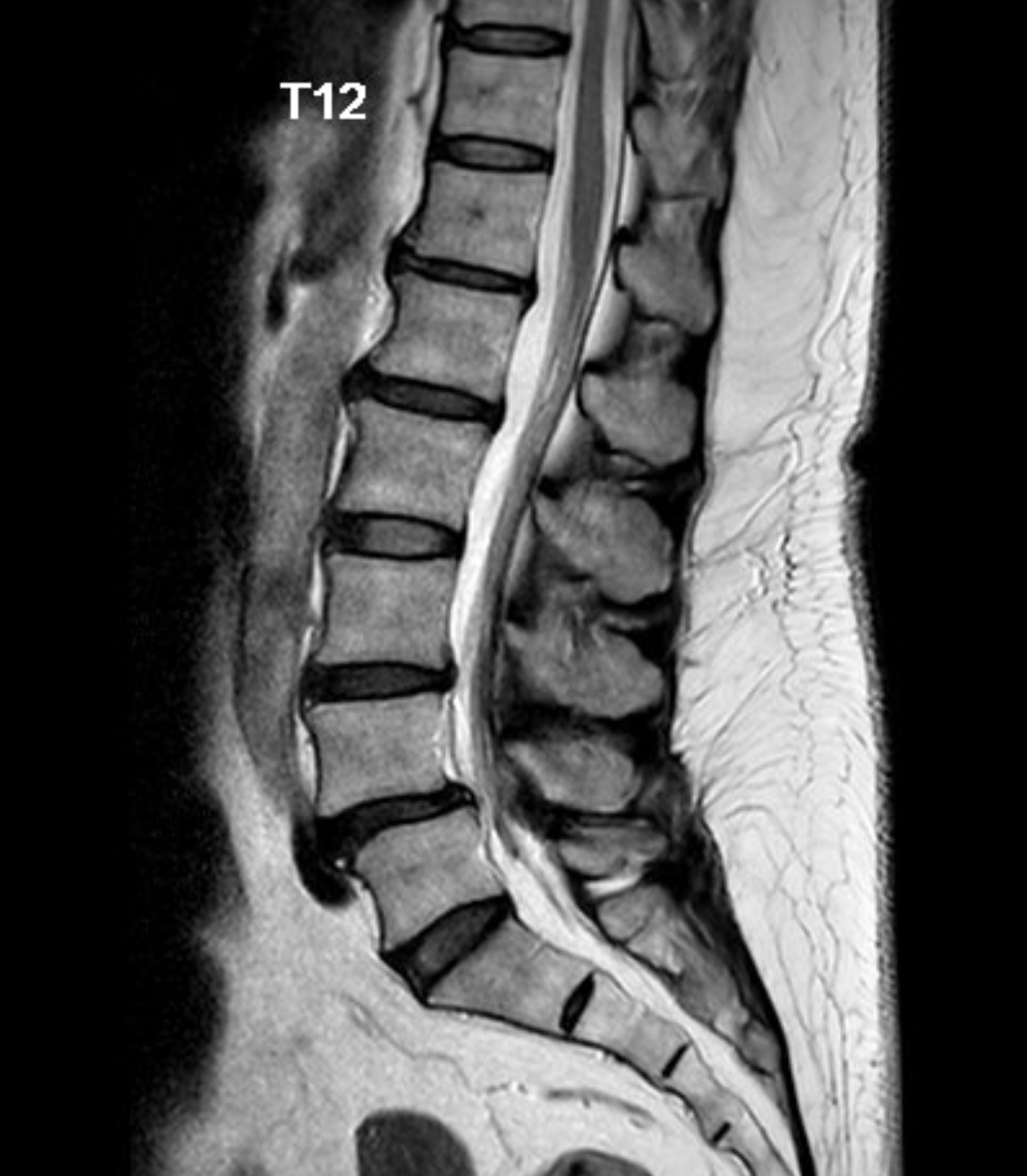 術前腰椎 MRI 顯示腰椎退化與神經壓迫位置
