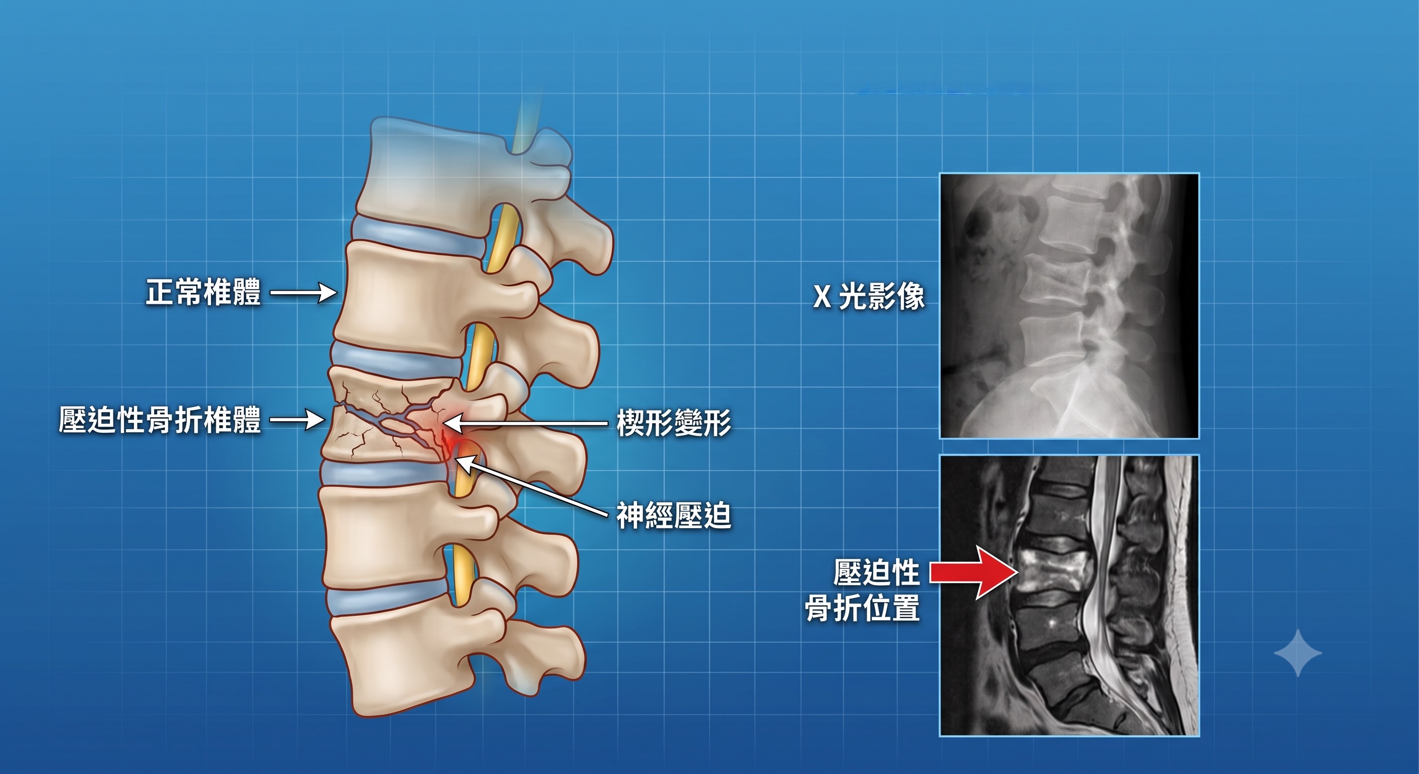 脊椎壓迫性骨折檢查與治療說明